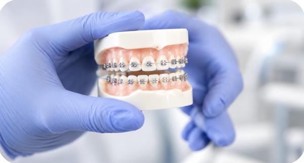 Moulage dentaire avec appareil orthodontique