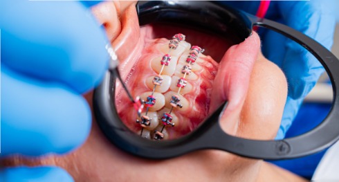 Contrôle d'un appareil orthodontique