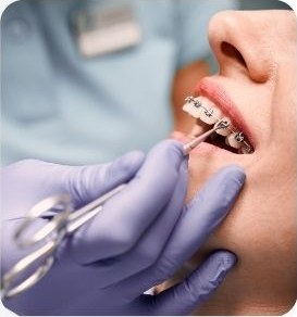 Contrôle d'un appareil orthodontique